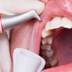 Check Up whitening step