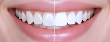 SEBARIS LASER WHITENING smile result
